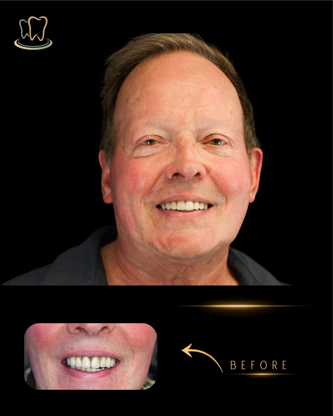 Case 5 — Digital Smile Design, Crowns & Veneers, Dental Implant before and after at Surrey Quays Dental Practice