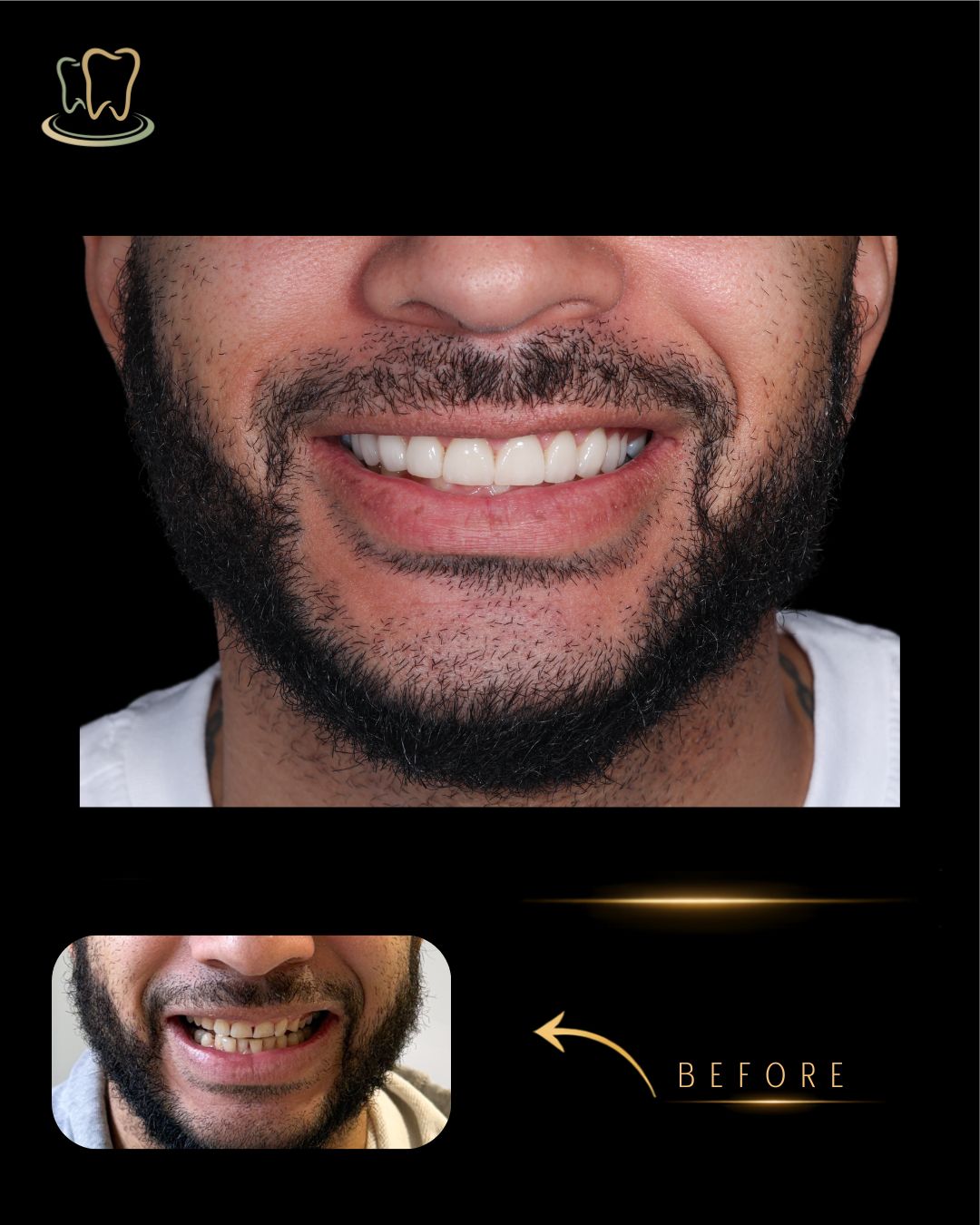 Case 6 — Digital Smile Design, Gum Contouring, Veneers before and after at Surrey Quays Dental Practice