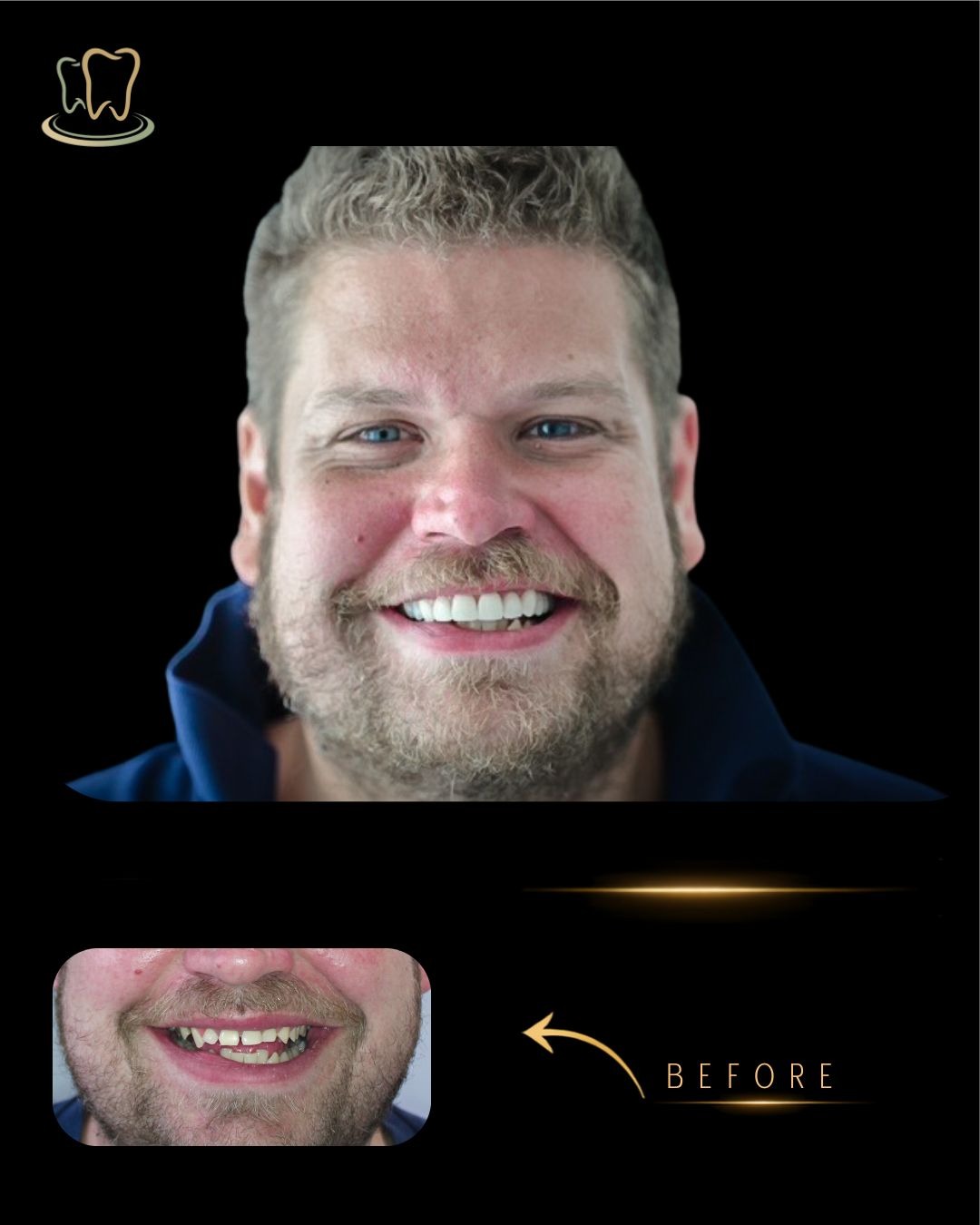 Case 7 — Digital Smile Design, Crowns, Full Mouth Rehabilitation before and after at Surrey Quays Dental Practice
