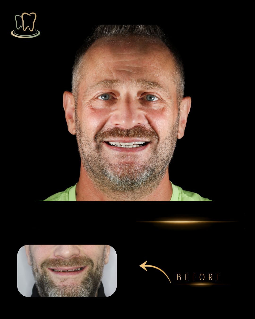 Case 8 — Digital Smile Design, Full Mouth Rehabilitation, Crowns & Veneers, Dental Implant before and after at Surrey Quays Dental Practice