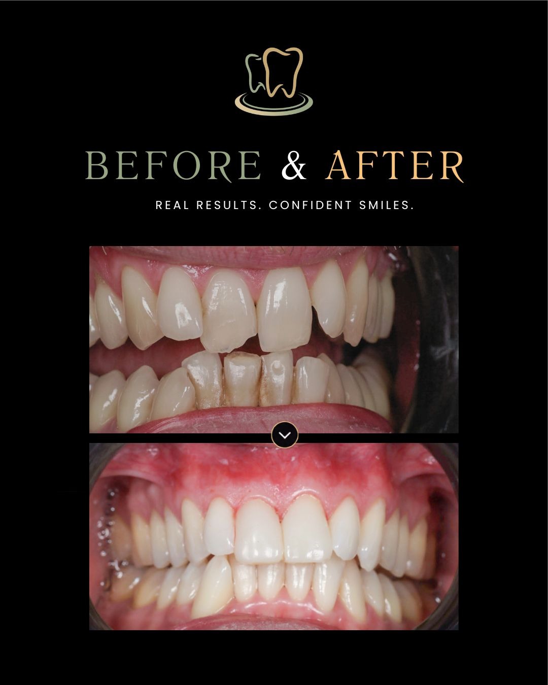 Case 9 — Digital Smile Design, Full Mouth Rehabilitation before and after at Surrey Quays Dental Practice
